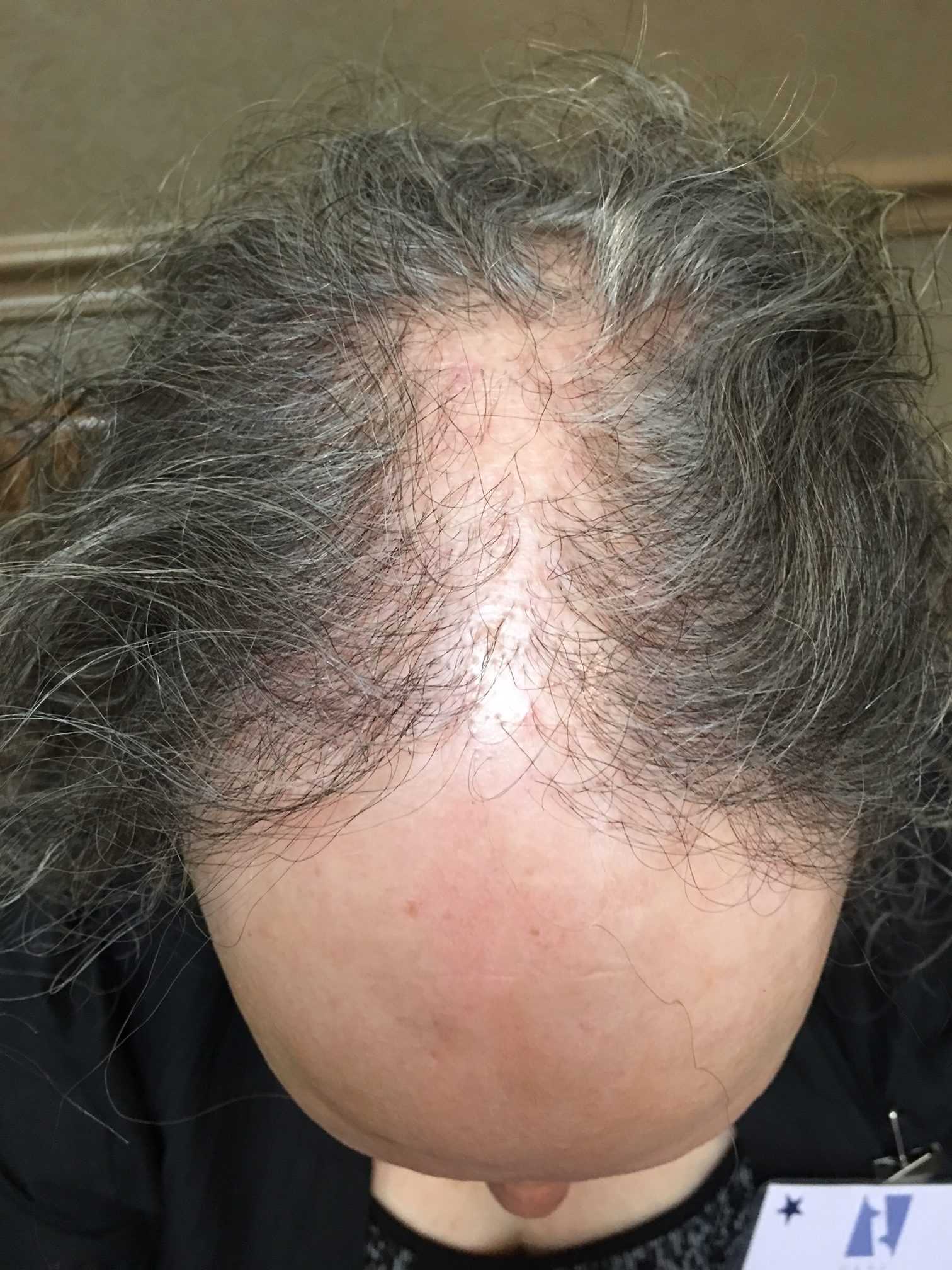 navigating-hair-loss-article