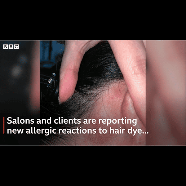 allergic reaction rash from hair color after having COVID-19