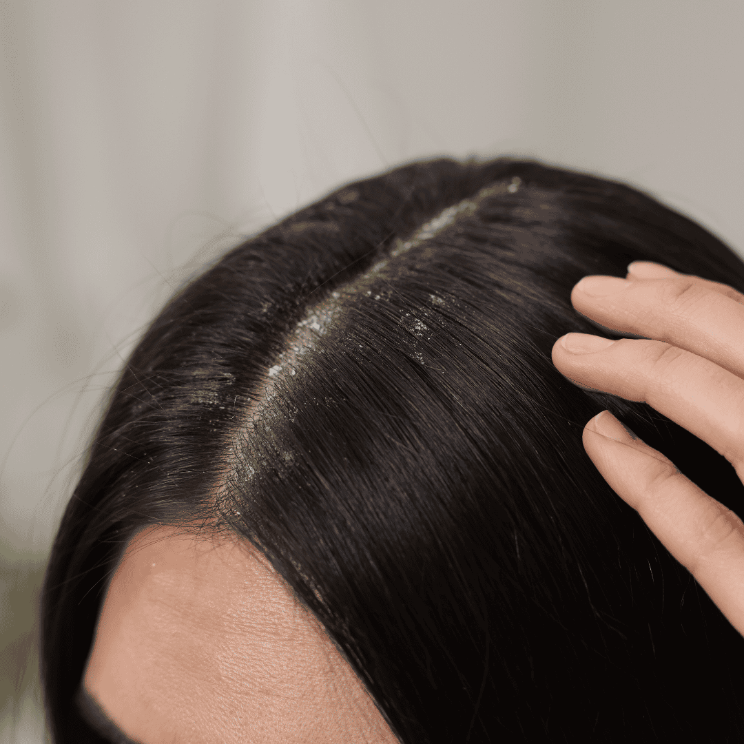 what is a moldy scalp